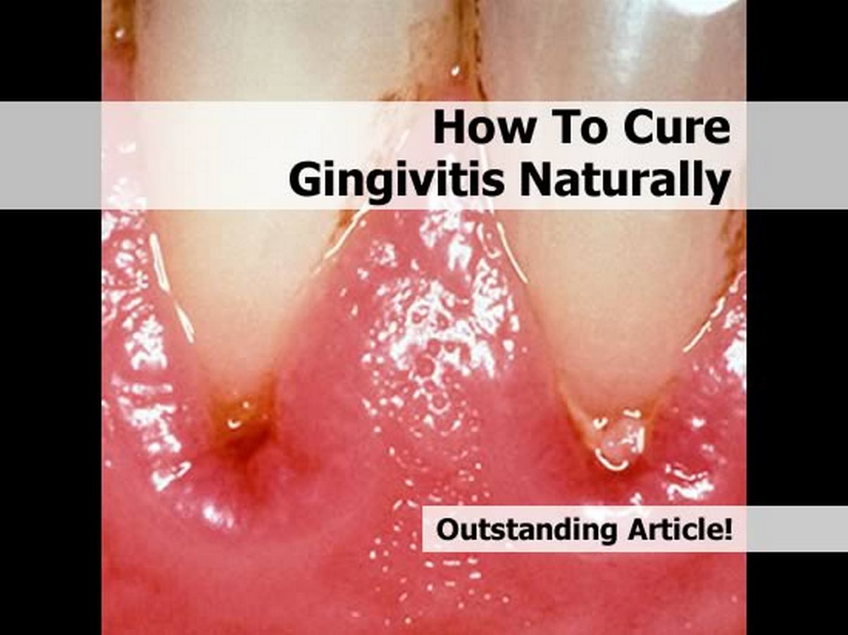 How To Cure Gingivitis Naturally