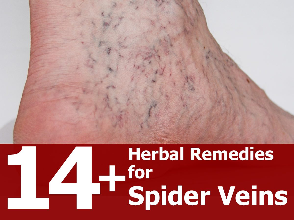 14 Amazing Herbal Remedies For Spider Veins